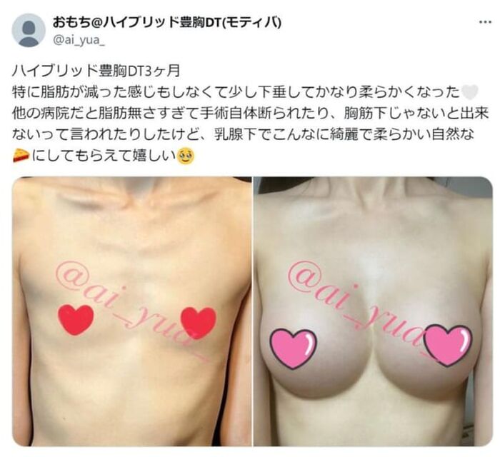 [With image] Super small breasts, reborn with breast augmentation surgery wwwww 2th image